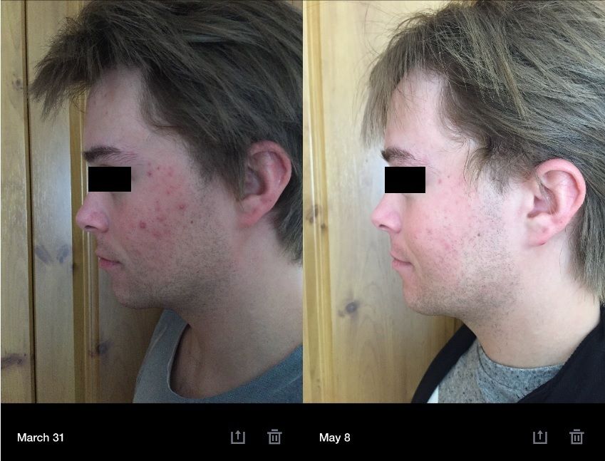 Accutane healing quality